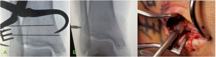 Dr Palmer Medial Malleous Fracture 3