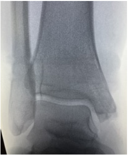 Dr Palmer Medial Malleous Fracture 4