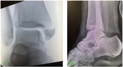 Dr Palmer Medial Malleous Fracture
